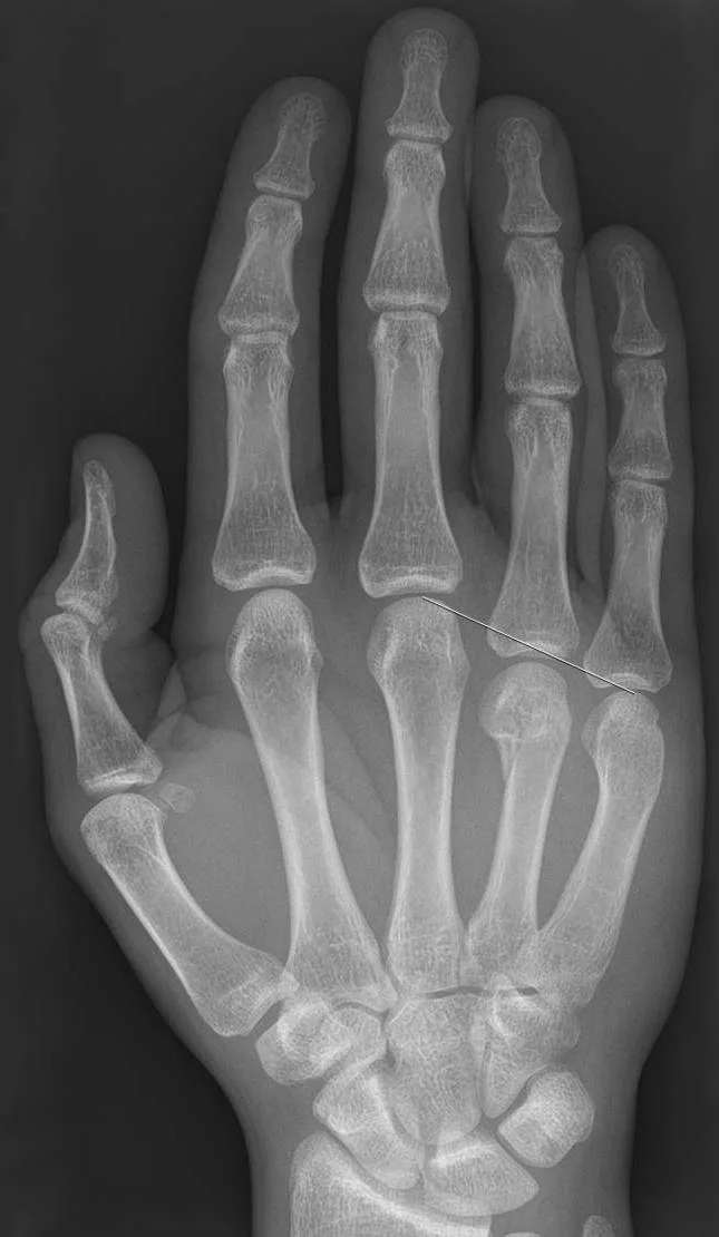 Upper limb radiograph for self-assessment