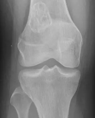 Radiograph from the case bank: Non-ossifying fibroma