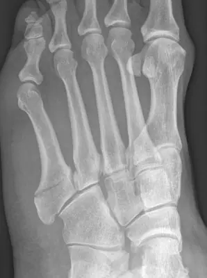 Radiograph from the case bank: Fifth metatarsal fracture (Jones / base)