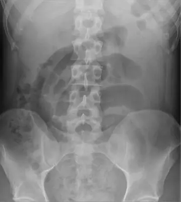 Radiograph from the case bank: Bowel obstruction