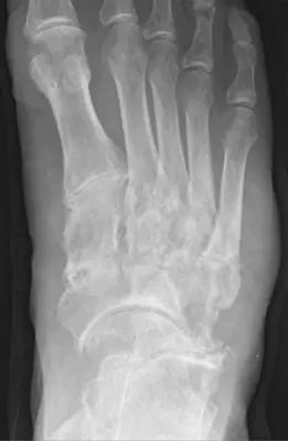 Radiograph from the case bank: Gout