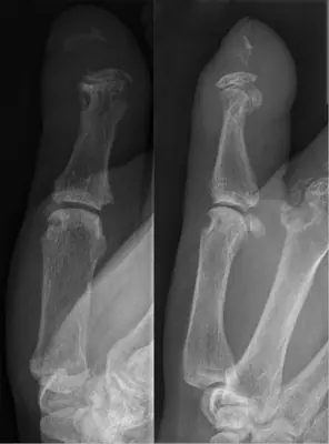 Radiograph from the case bank: Rheumatoid arthritis