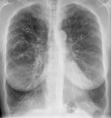 Radiograph from the case bank: Emphysema / COPD (hyperinflation)