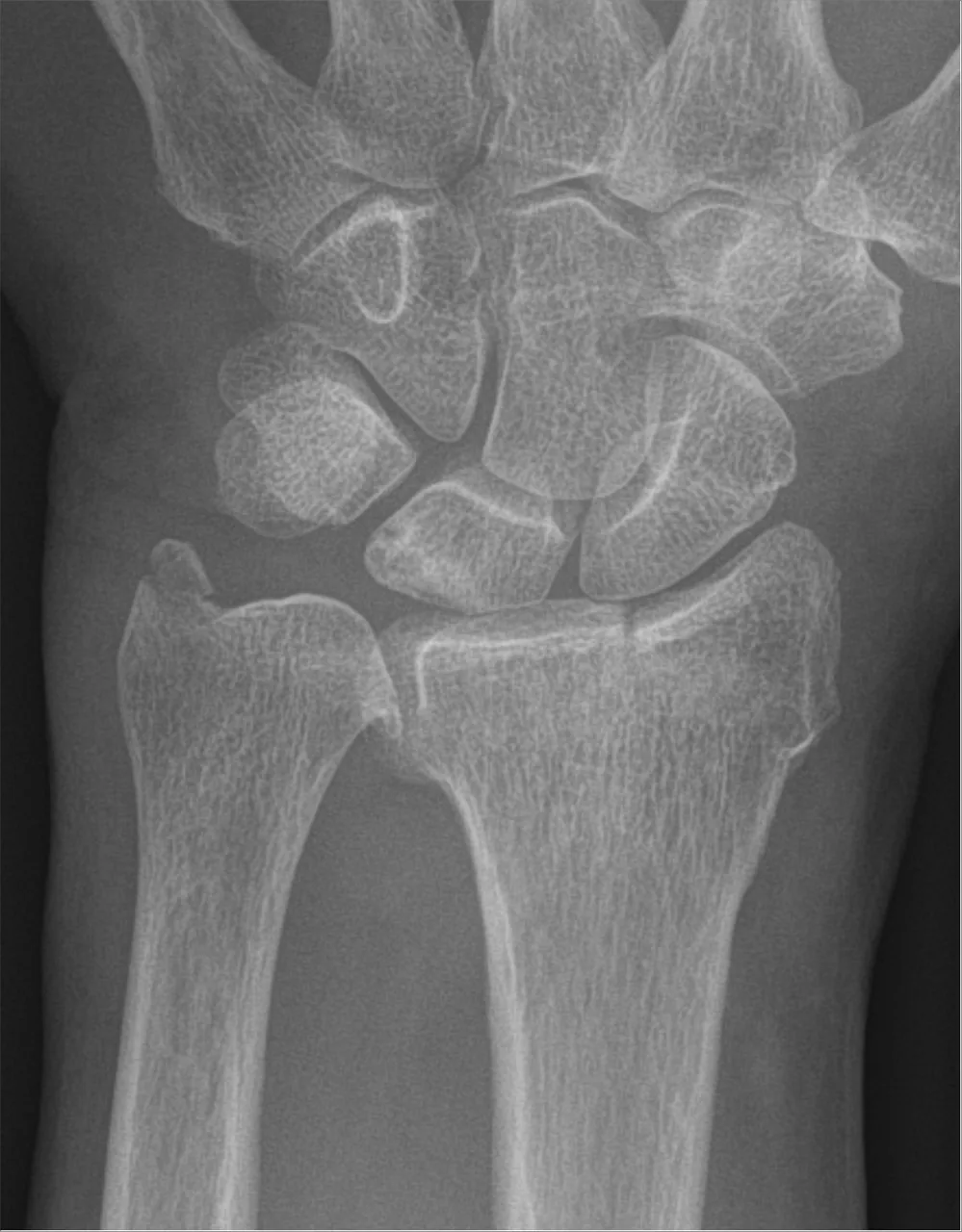 Upper limb radiograph for self-assessment