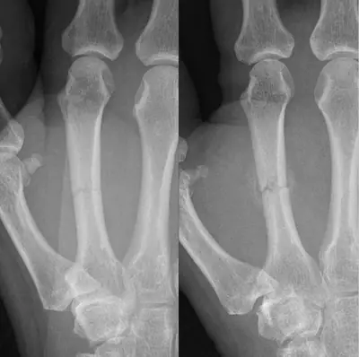 Radiograph from the case bank: Metacarpal fracture