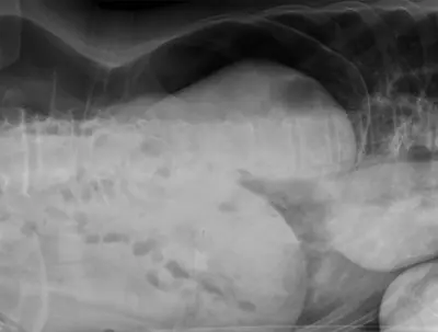 Radiograph from the case bank: Pneumoperitoneum (free intraperitoneal gas)