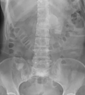 Radiograph from the case bank: Pneumoperitoneum (free intraperitoneal gas)